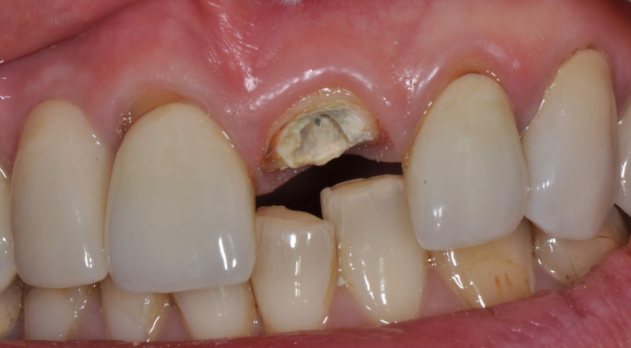 An upper front tooth broken off at the gum line, its crown displaced into the gap