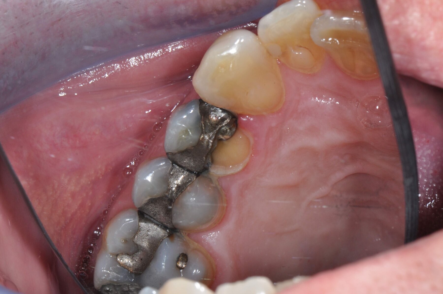Occlusal view of heavily filled molars with large silver amalgam fillings and little natural tooth structure remaining