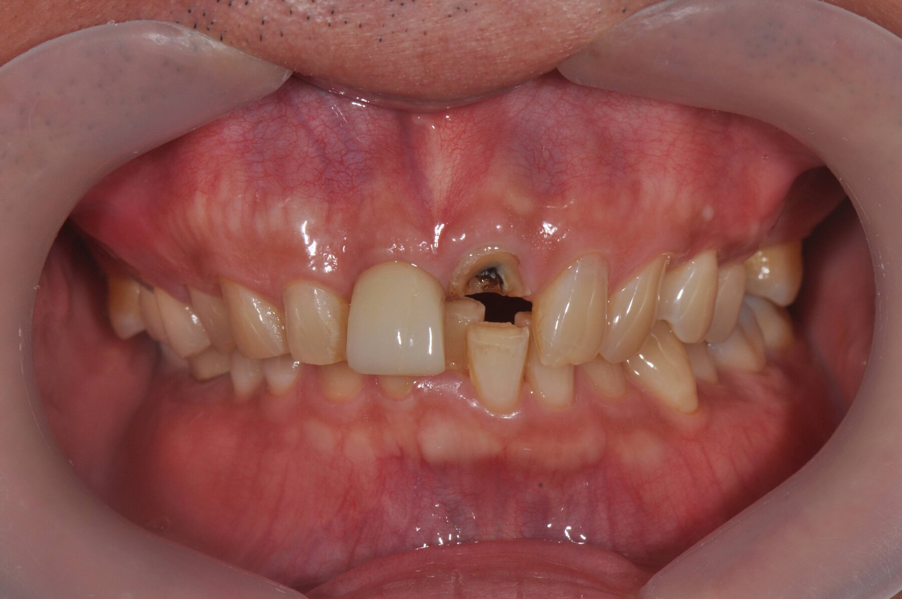 A fractured upper front tooth broken down toward the gum line, with only part of the crown remaining
