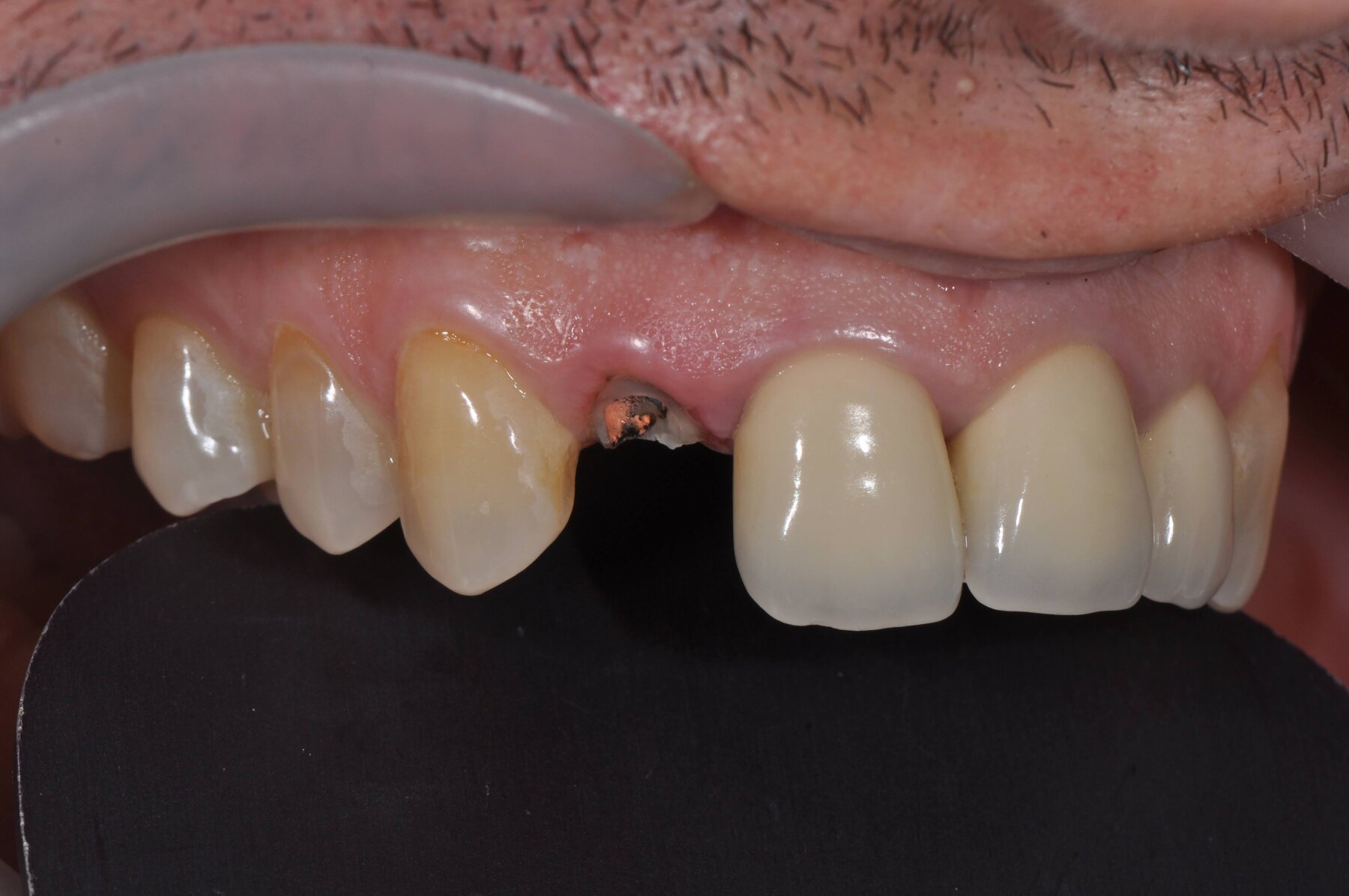 Close-up of a root-treated front tooth fractured at the gum line, leaving only the root and a metal post behind